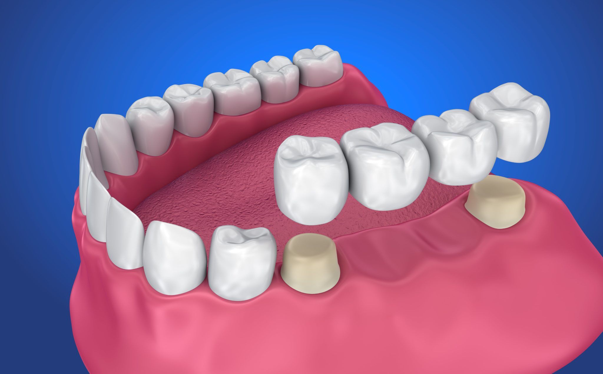 Best Crown And Bridges Treatment In Vijayapura Best Crown And Bridges Treatment In Vijayapura