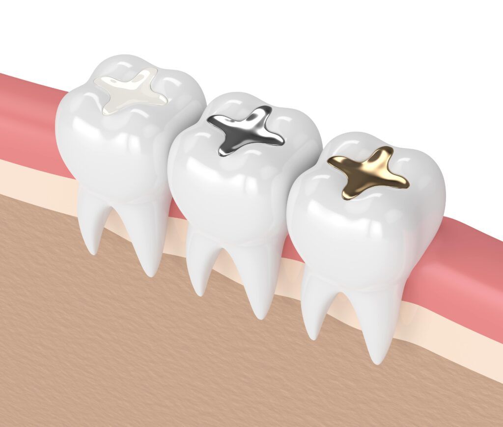 Dental Filling Treatment in Vijayapura Dental Filling Treatment in Vijayapura