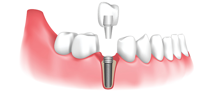 Dental Implants Treatment In Vijayapura