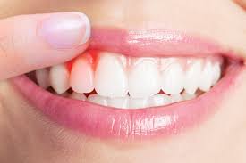 Gum Treatment In Vijayapura