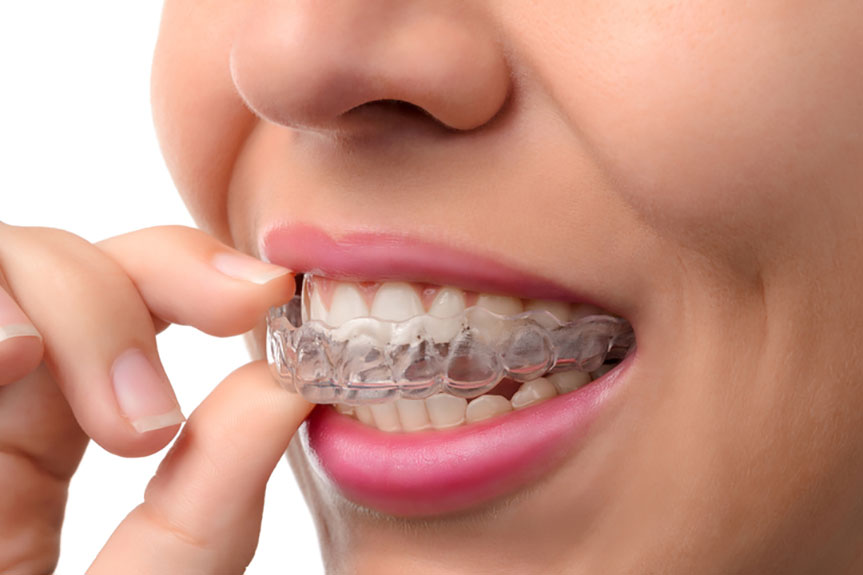 Invisible Braces Treatment In Vijayapura