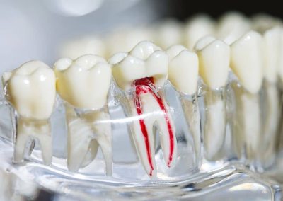 Root Canal Treatments In Vijayapura