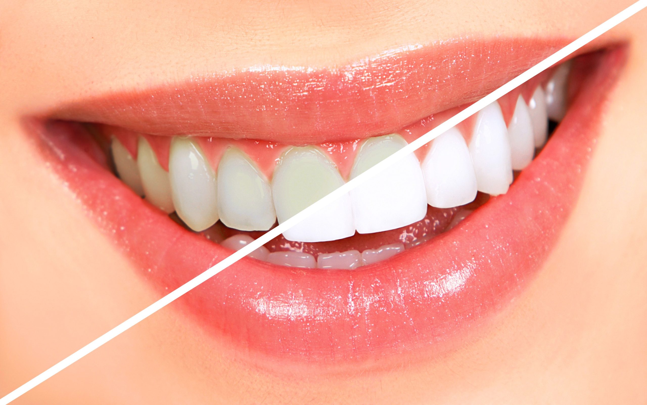 Teeth Whitening Treatment In Vijayapura