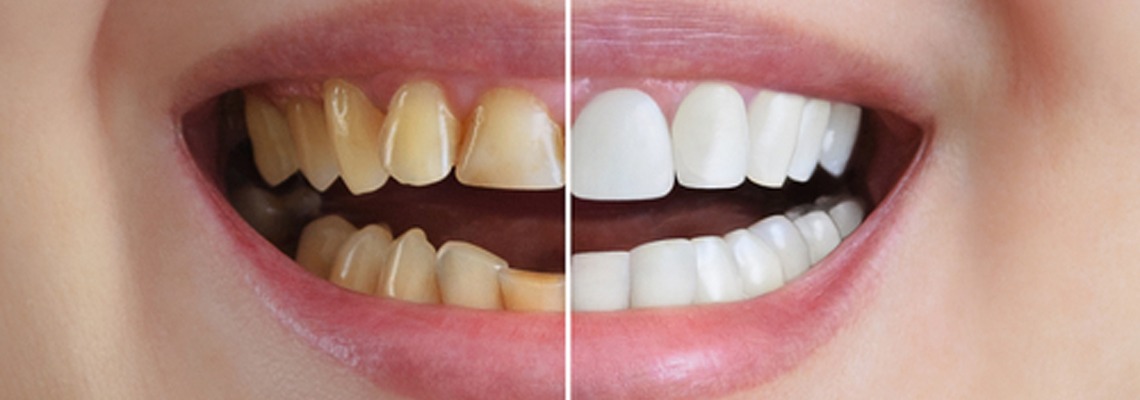 Full Mouth Rehabilitation Treatment Vijayapura
